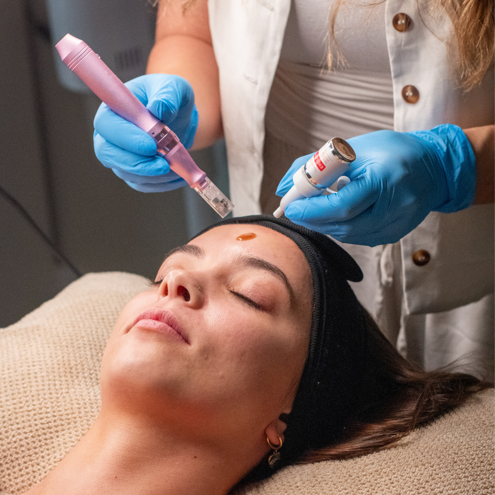 Limpieza + Exosomas con Dermapen