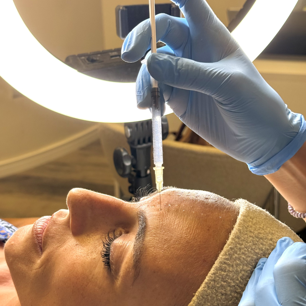 Mesoterapia Facial