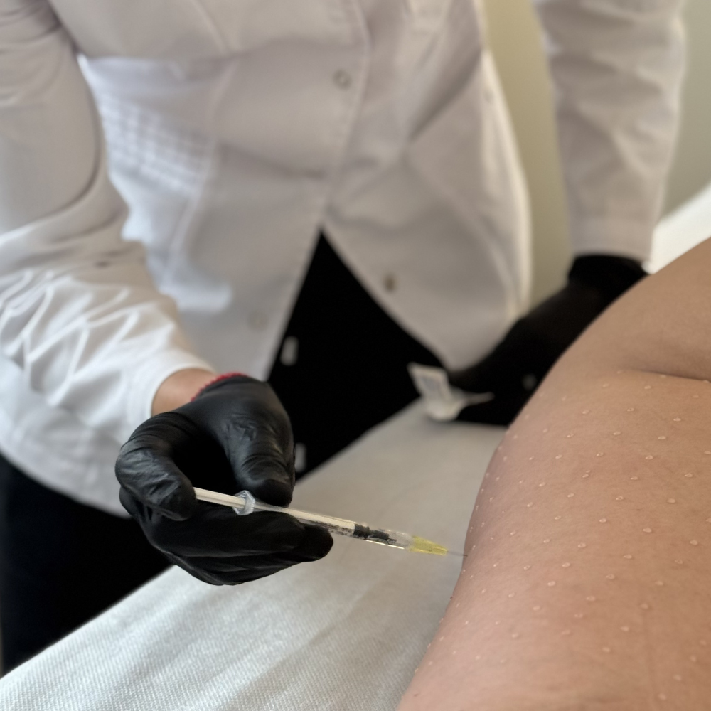 Mesoterapia Corporal